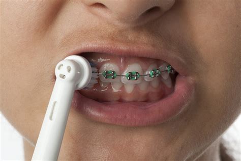 Can I Use Electric Toothbrush with Braces? Exploring the Myths and Realities of Oral Hygiene with Orthodontic Appliances